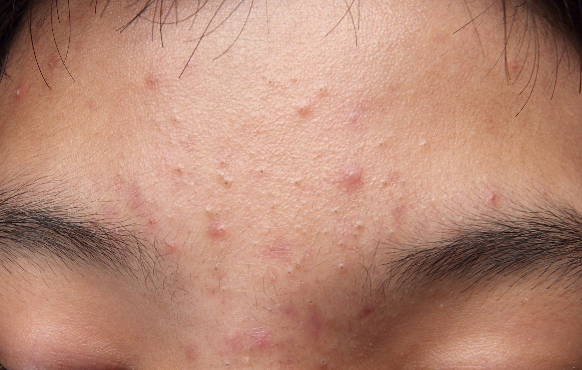 Close-up of skin, oily and dehydrated at the same time
