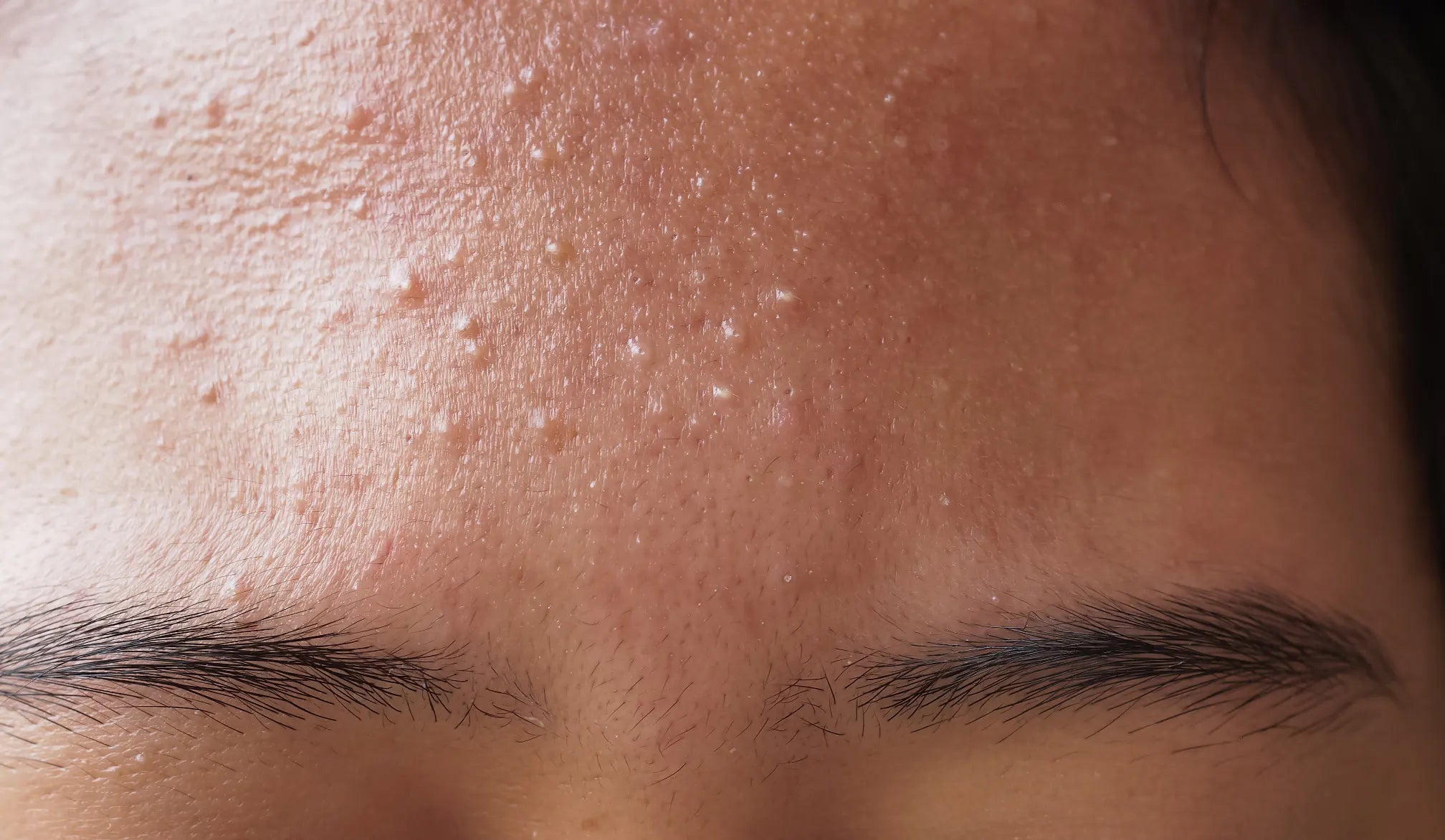 Fungal Acne: Why Those Tiny Bumps Won't Budge