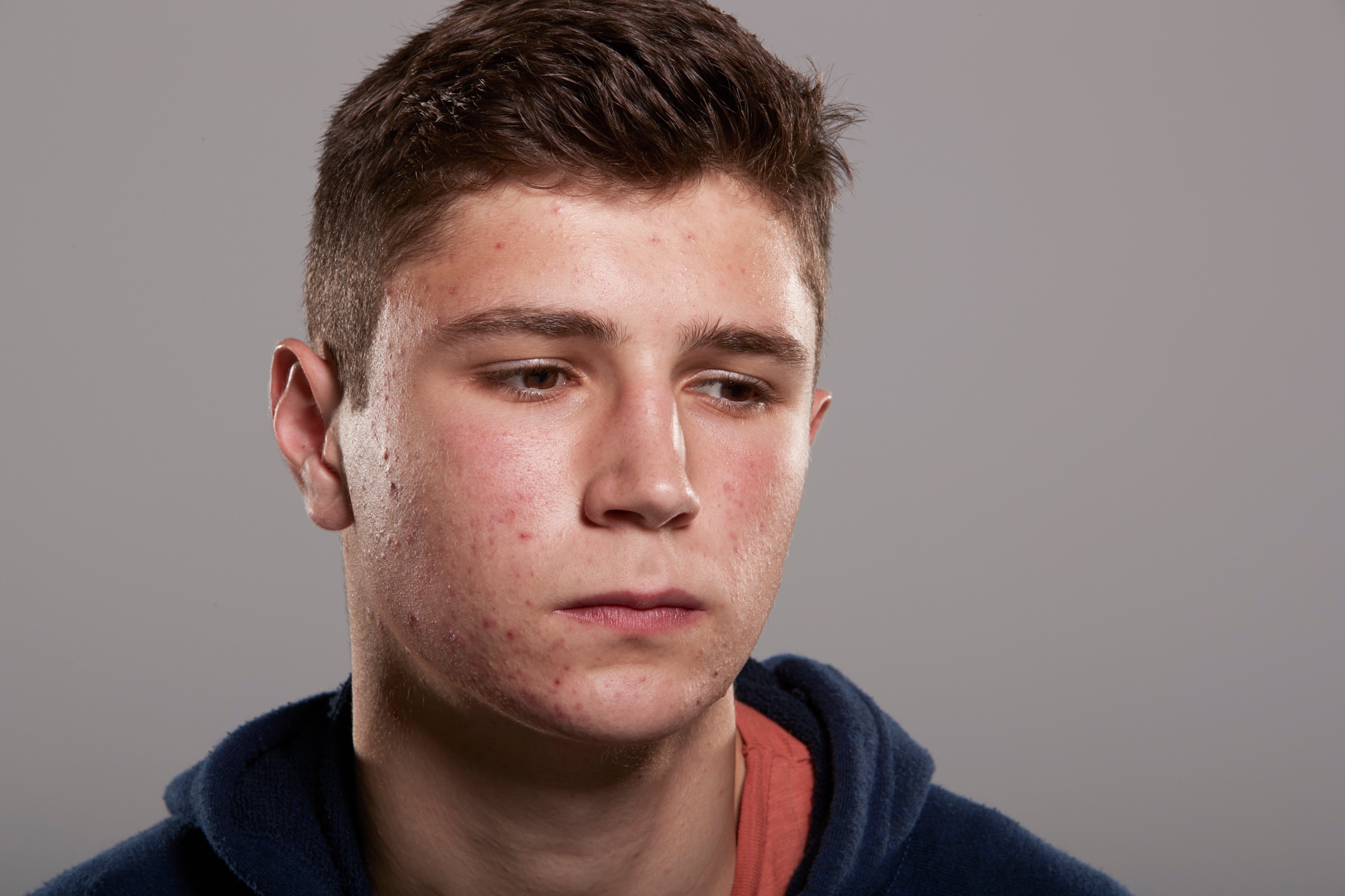 Top 10 skincare mistakes that are making your acne worse