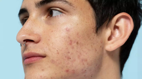 Acne 101: The Different Types of Acne and How to Treat Them