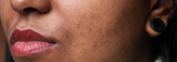 How to Tackle Hyperpigmentation and Even Out Skin Tone
