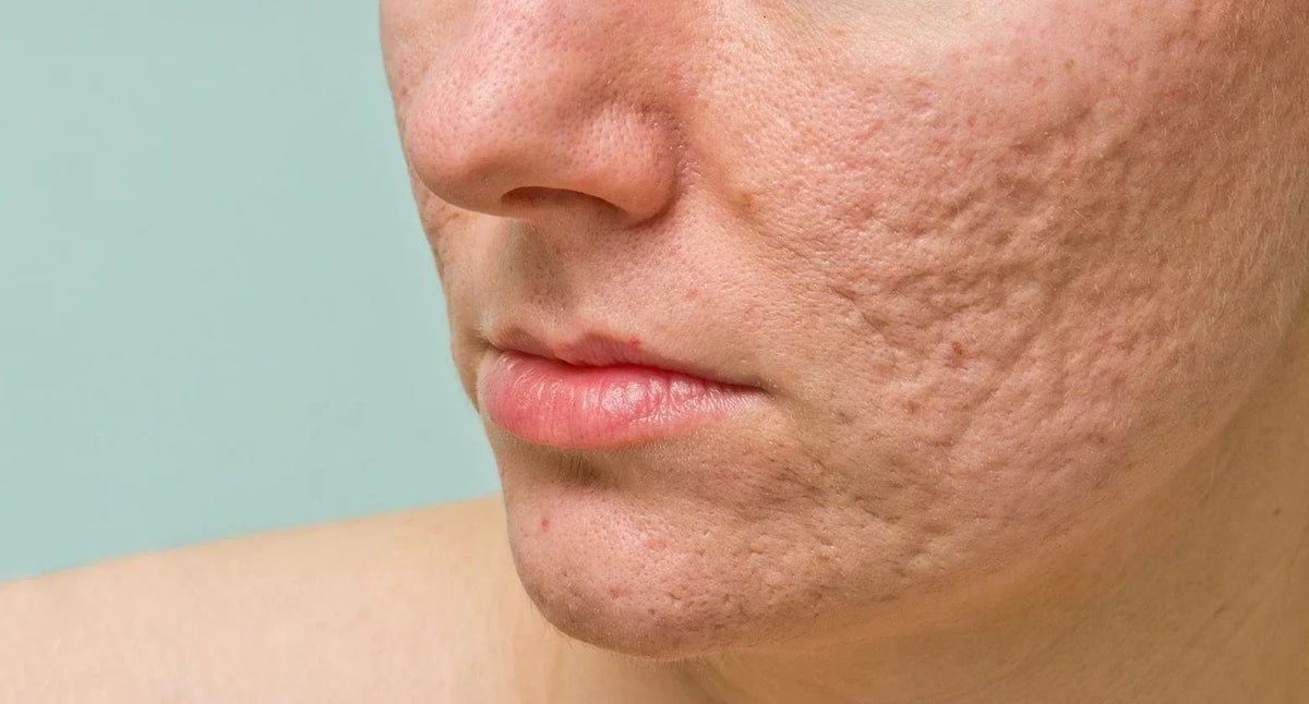True Scars What Is Atrophic Scarring? Causes, Treatments, and Prevention