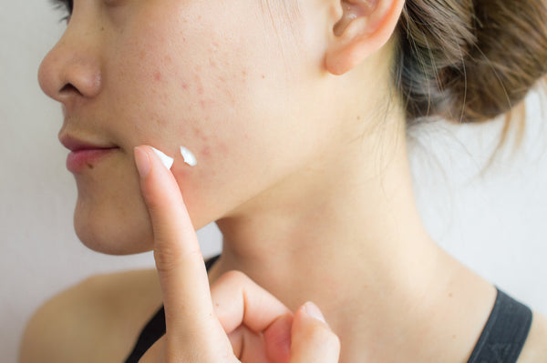 Ingredients you should avoid for acne-prone skin